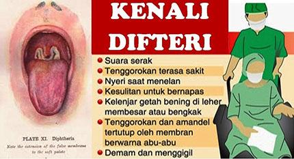 Di Indonesia, Serum Anti Difteri Masih Langka