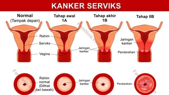 Kanker Serviks Bisa Sebabkan Kematian Setelah 10 Tahun