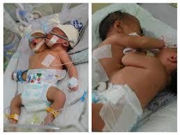 Tim Dokter Belum Bisa Pastikan Jadwal Operasi Pemisahan Bayi Kembar Siam