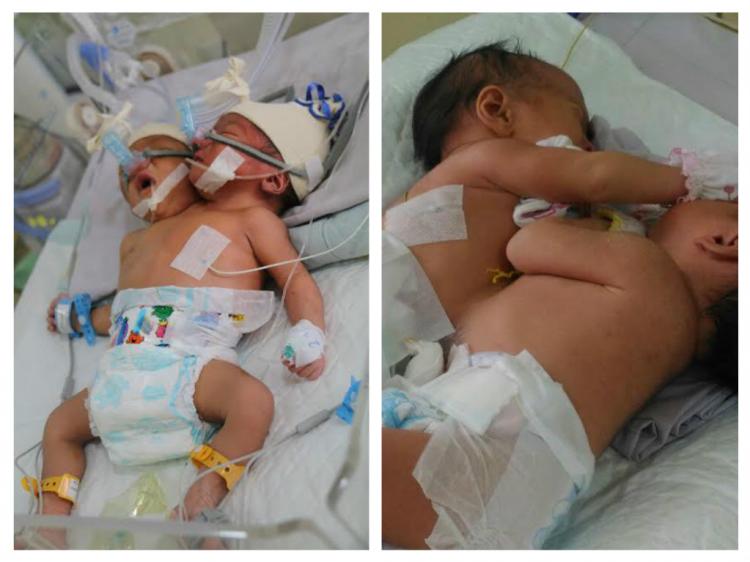 Bayi Perempuan Kembar Siam Dempet Dada di RSUP Adam Malik Sudah Bisa Minum ASI