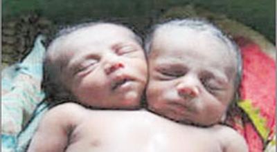 Bayi Kembar Siam Berkepala Dua Meninggal Akibat Sesak Napas