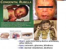 Sebanyak 100 Ribu Bayi Terlahir dengan Rubella Kongenital