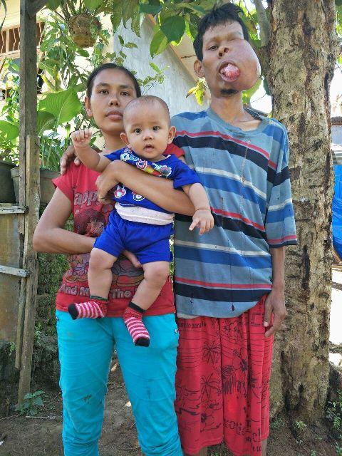 Divonis Derita Tumor Wajah, Sapri Butuh Uluran Tangan Dermawan