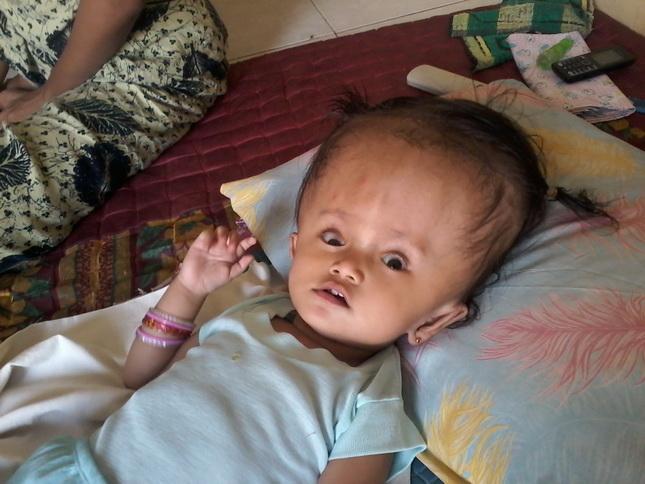 Bayi Zahra Lestari  Harapkan Bantuan Dermawan dan Program KIS