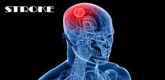 Penyakit Stroke Masih Dapat Disembuhkan