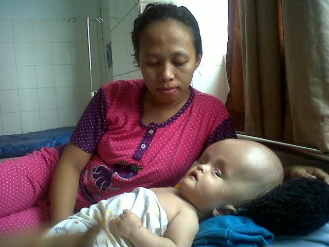 Tak Punya Biaya Perobatan, Orangtua Bayi Penderita Hydroshepalus Pasrah