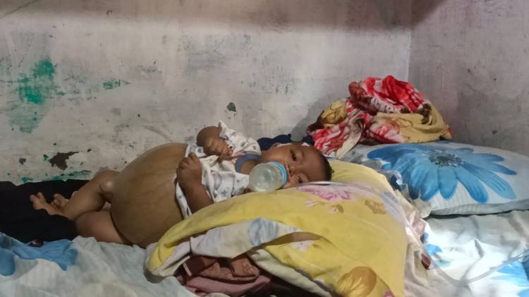  Bayi Penderita Atresia Bilier Butuh  Bantuan