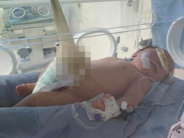 Dalam Perawatan Intensif di RSUP H Adam Malik, Bayi Perempuan Asal Kisaran Lahir dengan Usus di Luar