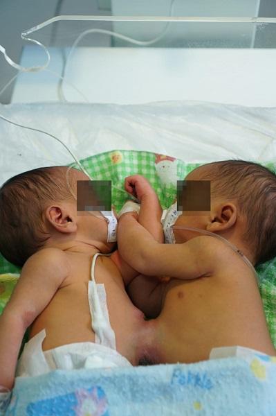 RSUP Haji Adam Malik Medan Rawat Bayi Kembar Siam Asal Taput