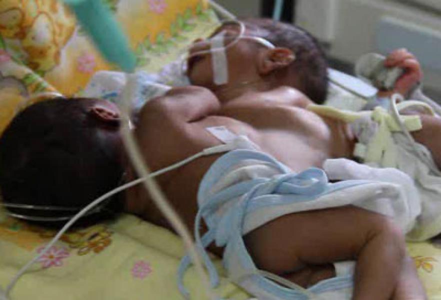 Bayi Kembar Siam Dempet Dada dan Perut Lahir di Tembung