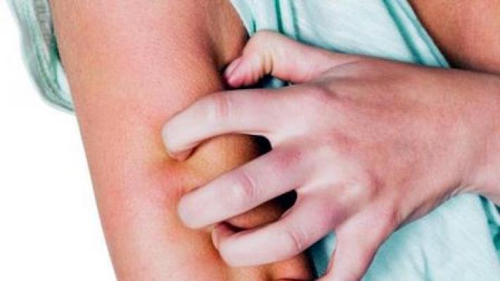 Penderita Kusta Harus Lakukan Pengobatan Dini Sebelum Alami Kecacatan Seumur Hidup